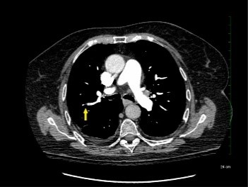 image of blood clot in lungs